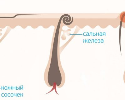 Вросшие волосы